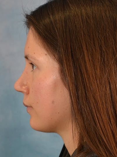 Rhinoplasty Before & After Gallery - Patient 146208553 - Image 2