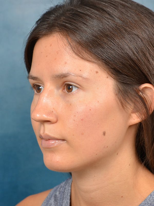 Rhinoplasty Before & After Gallery - Patient 146208553 - Image 3