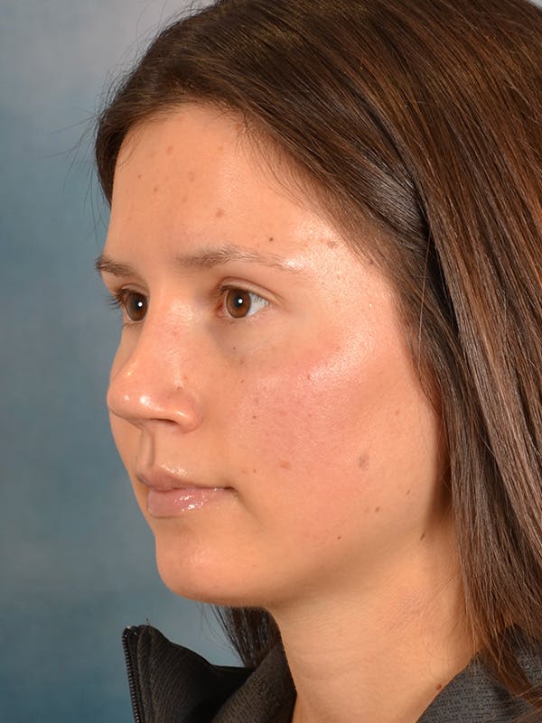 Rhinoplasty Before & After Gallery - Patient 146208553 - Image 4