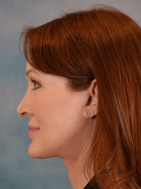 Deep Plane Facelift Before & After Gallery - Patient 146208595 - Image 10