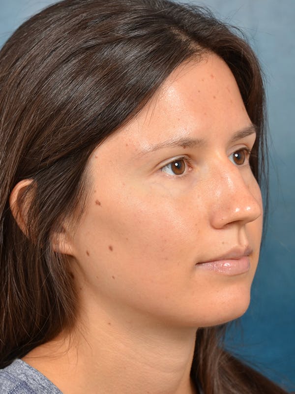Rhinoplasty Before & After Gallery - Patient 146208553 - Image 7