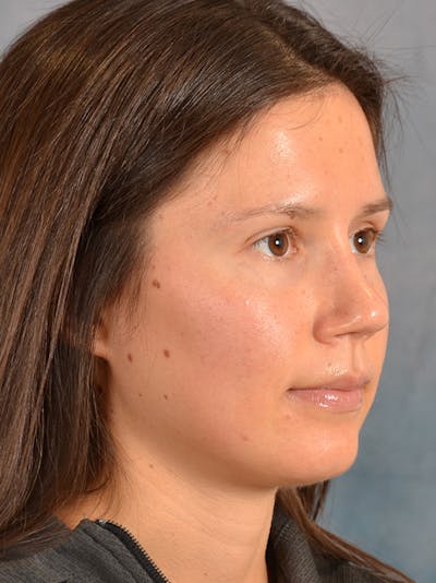 Rhinoplasty Before & After Gallery - Patient 146208553 - Image 8