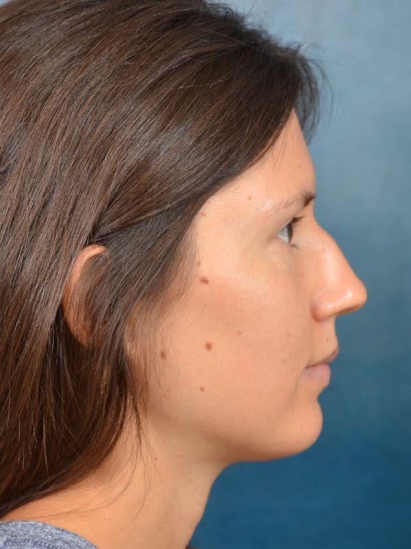 Rhinoplasty Before & After Gallery - Patient 146208553 - Image 9