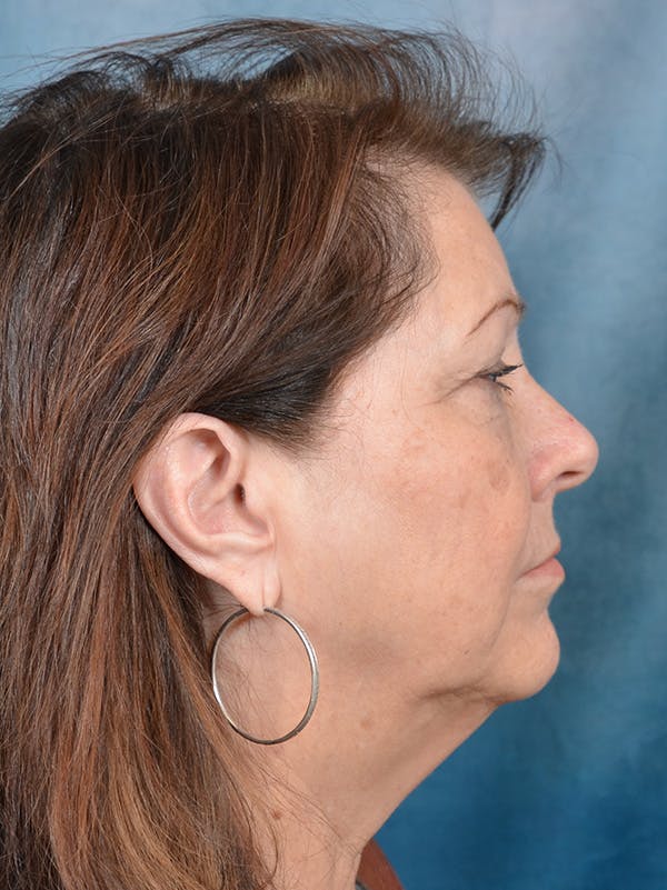 Eyelid Lift Before & After Gallery - Patient 146208685 - Image 5