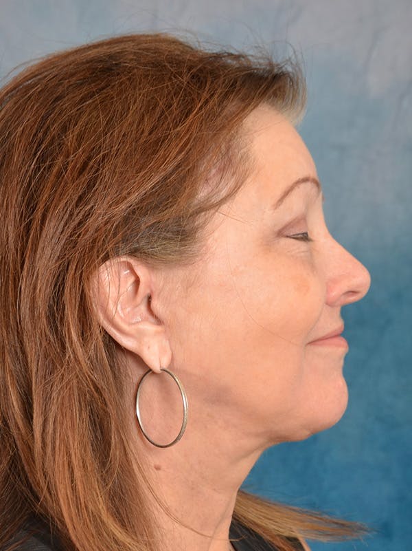 Eyelid Lift Before & After Gallery - Patient 146208685 - Image 6