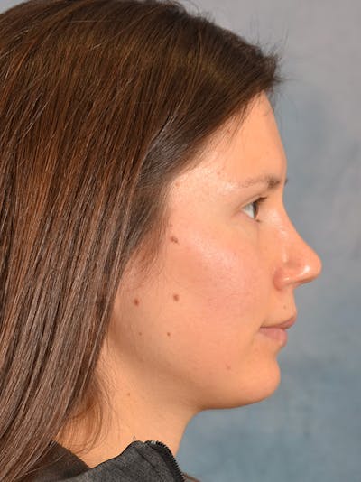Rhinoplasty Before & After Gallery - Patient 146208553 - Image 10