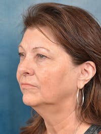 Deep Plane Facelift Before & After Gallery - Patient 146208691 - Image 1