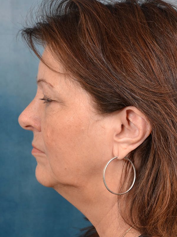Eyelid Lift Before & After Gallery - Patient 146208685 - Image 9
