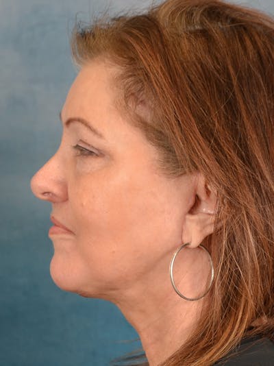 Eyelid Lift Before & After Gallery - Patient 146208685 - Image 10