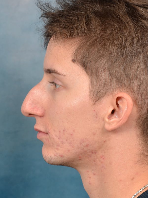 Rhinoplasty Before & After Gallery - Patient 146208575 - Image 1