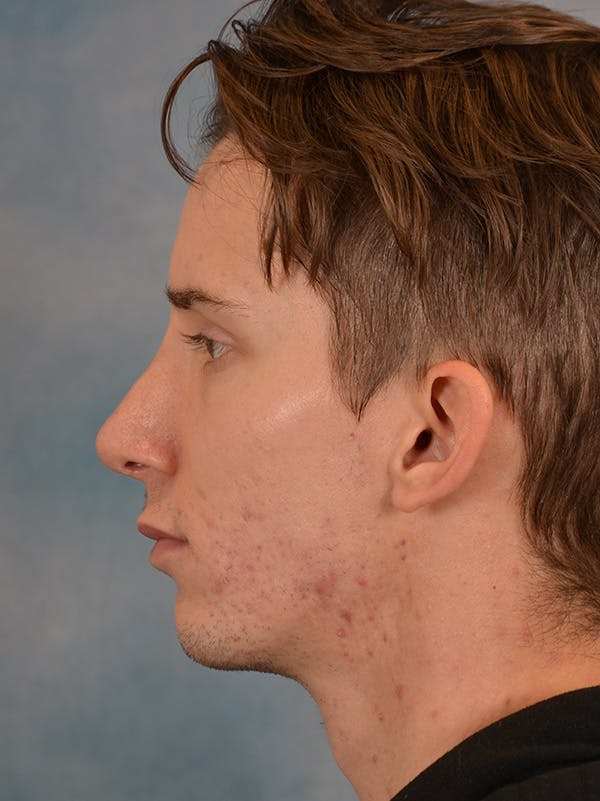 Rhinoplasty Before & After Gallery - Patient 146208575 - Image 2