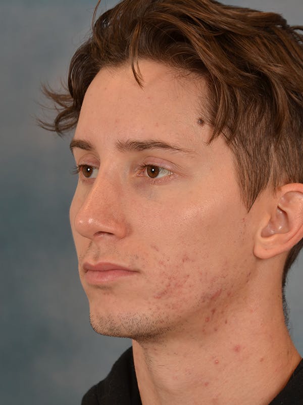 Rhinoplasty Before & After Gallery - Patient 146208575 - Image 4