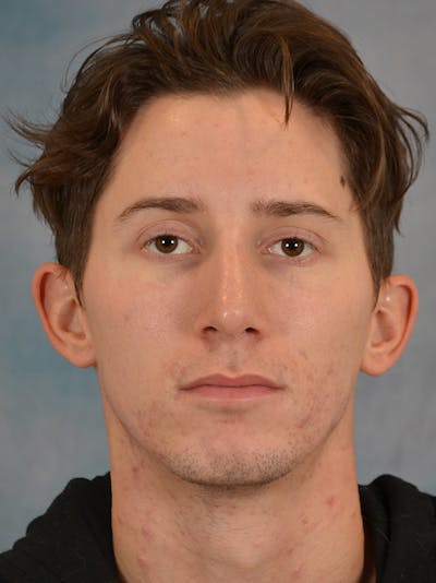 Rhinoplasty Before & After Gallery - Patient 146208575 - Image 6