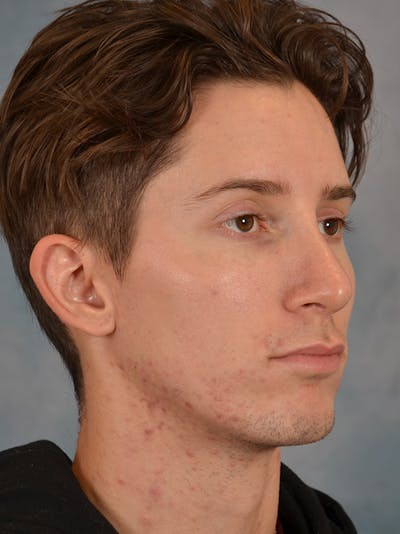 Rhinoplasty Before & After Gallery - Patient 146208575 - Image 8