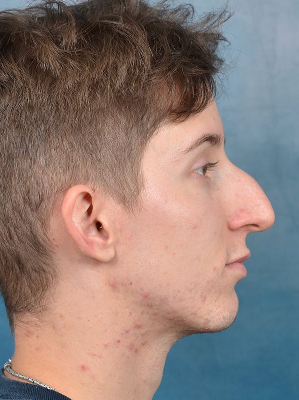 Rhinoplasty Before & After Gallery - Patient 146208575 - Image 9