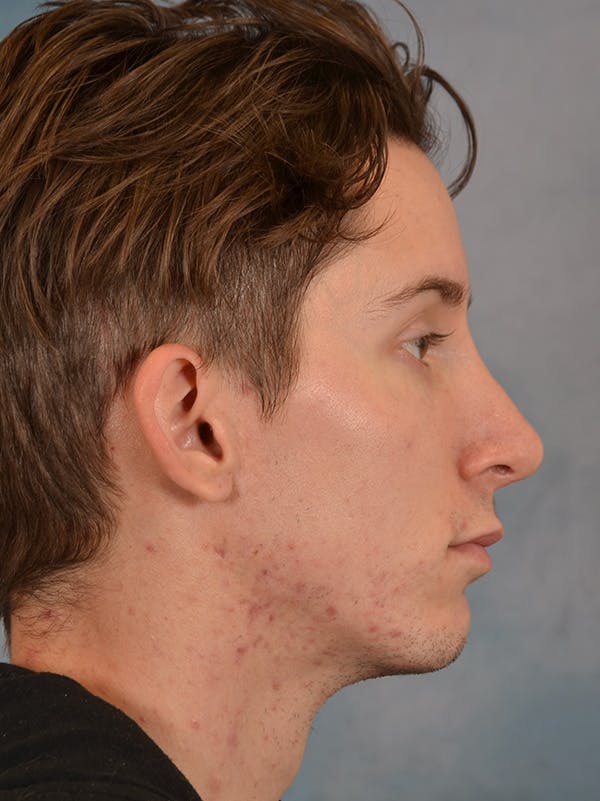 Rhinoplasty Before & After Gallery - Patient 146208575 - Image 10