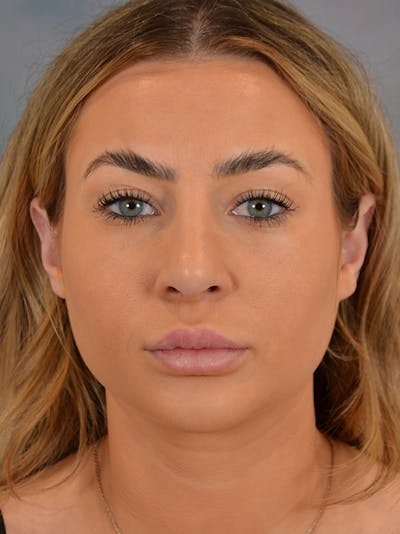 Chin Augmentation Before & After Gallery - Patient 148257049 - Image 2