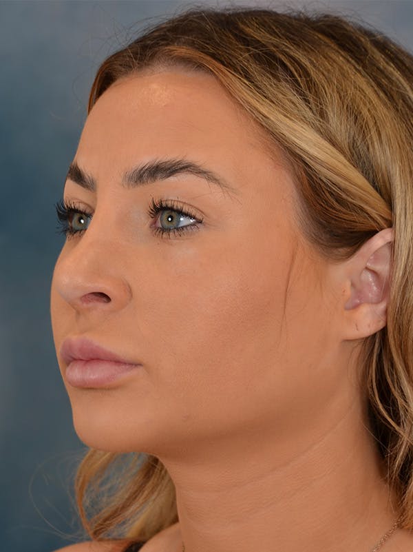 Chin Augmentation Before & After Gallery - Patient 148257049 - Image 4