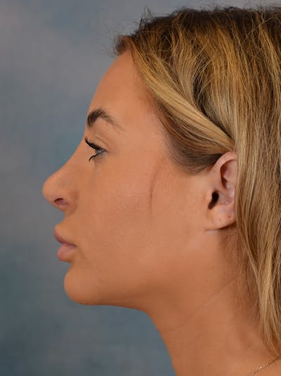 Chin Augmentation Before & After Gallery - Patient 148257049 - Image 6