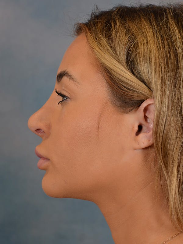 Rhinoplasty Before & After Gallery - Patient 146208574 - Image 2