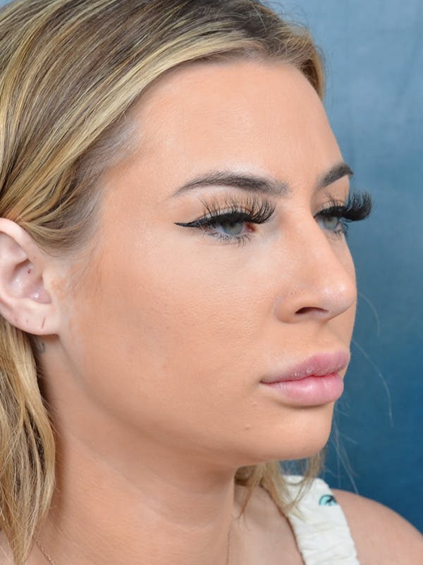 Rhinoplasty Before & After Gallery - Patient 146208574 - Image 7