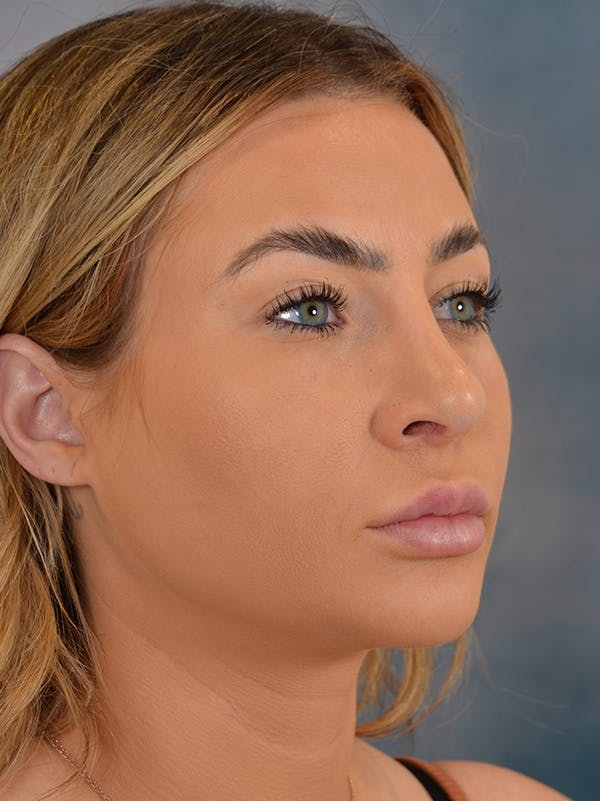 Rhinoplasty Before & After Gallery - Patient 146208574 - Image 8
