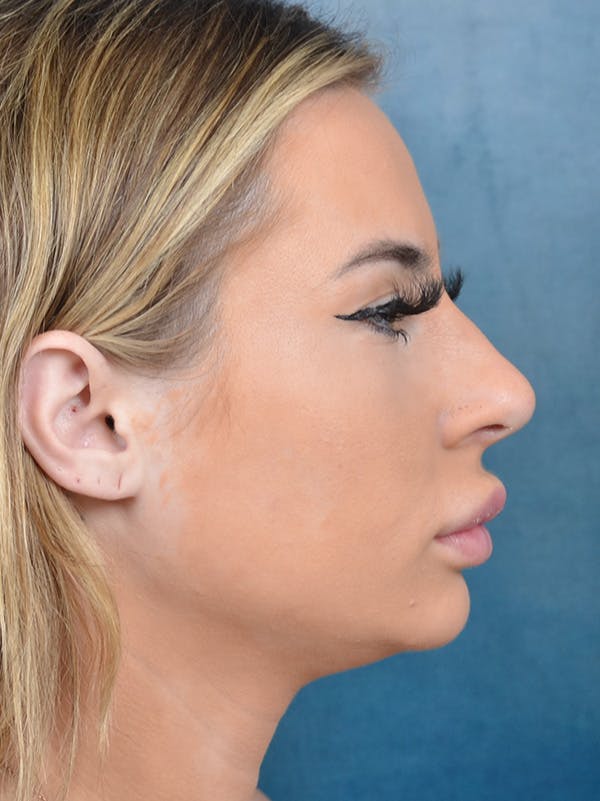 Neck Liposuction Before & After Gallery - Patient 146208578 - Image 9