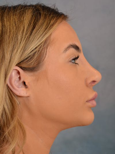 Rhinoplasty Before & After Gallery - Patient 146208574 - Image 10