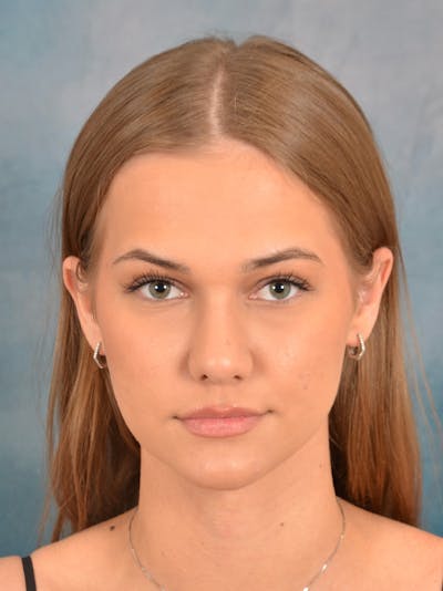 Rhinoplasty Before & After Gallery - Patient 146208676 - Image 4
