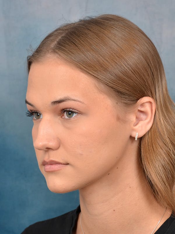 Rhinoplasty Before & After Gallery - Patient 146208676 - Image 5