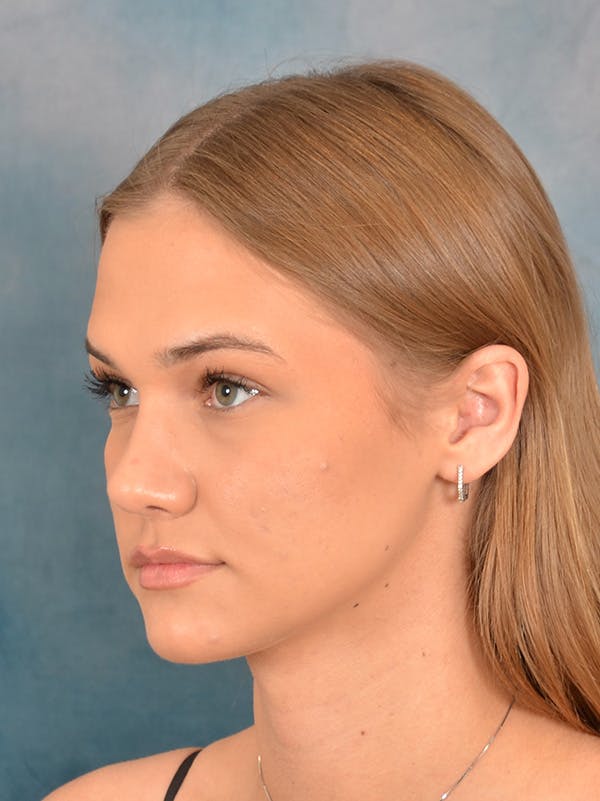 Rhinoplasty Before & After Gallery - Patient 146208676 - Image 6