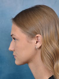 Rhinoplasty Before & After Gallery - Patient 146208676 - Image 1