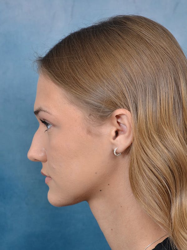 Rhinoplasty Before & After Gallery - Patient 146208676 - Image 1