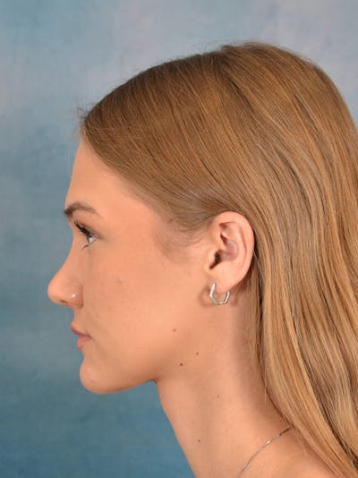 Rhinoplasty Before & After Gallery - Patient 146208676 - Image 2