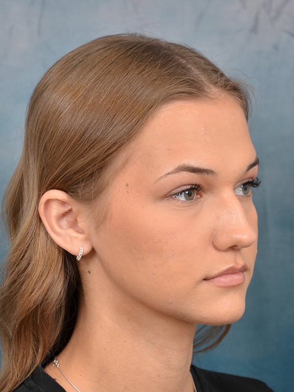 Rhinoplasty Before & After Gallery - Patient 146208676 - Image 7