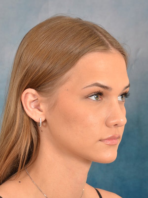 Rhinoplasty Before & After Gallery - Patient 146208676 - Image 8