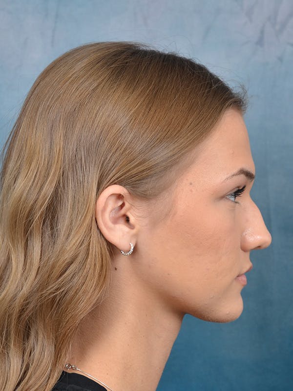 Rhinoplasty Before & After Gallery - Patient 146208676 - Image 9