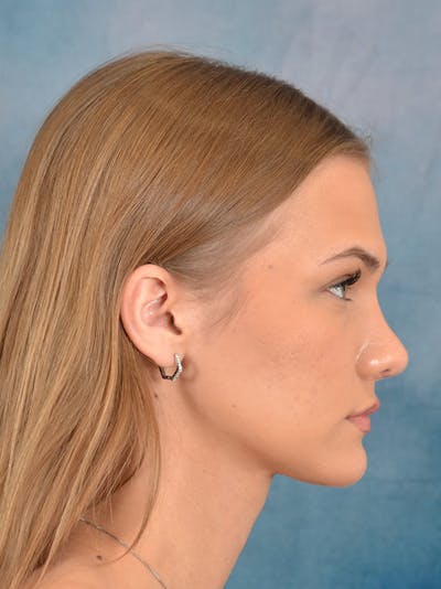 Rhinoplasty Before & After Gallery - Patient 146208676 - Image 10