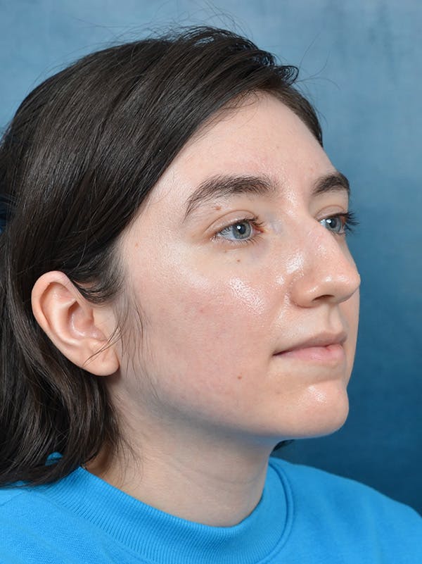 Rhinoplasty Before & After Gallery - Patient 146804354 - Image 5