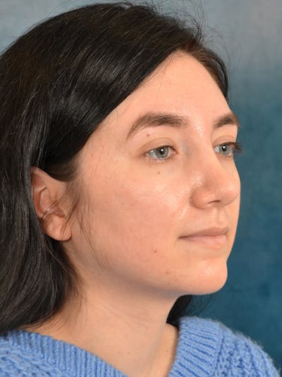 Rhinoplasty Before & After Gallery - Patient 146804354 - Image 6