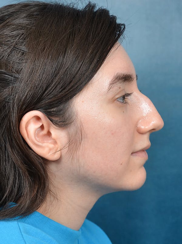 Rhinoplasty Before & After Gallery - Patient 146804354 - Image 7