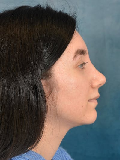 Rhinoplasty Before & After Gallery - Patient 146804354 - Image 8