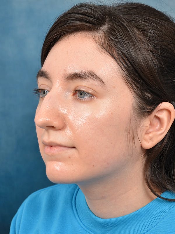 Rhinoplasty Before & After Gallery - Patient 146804354 - Image 9