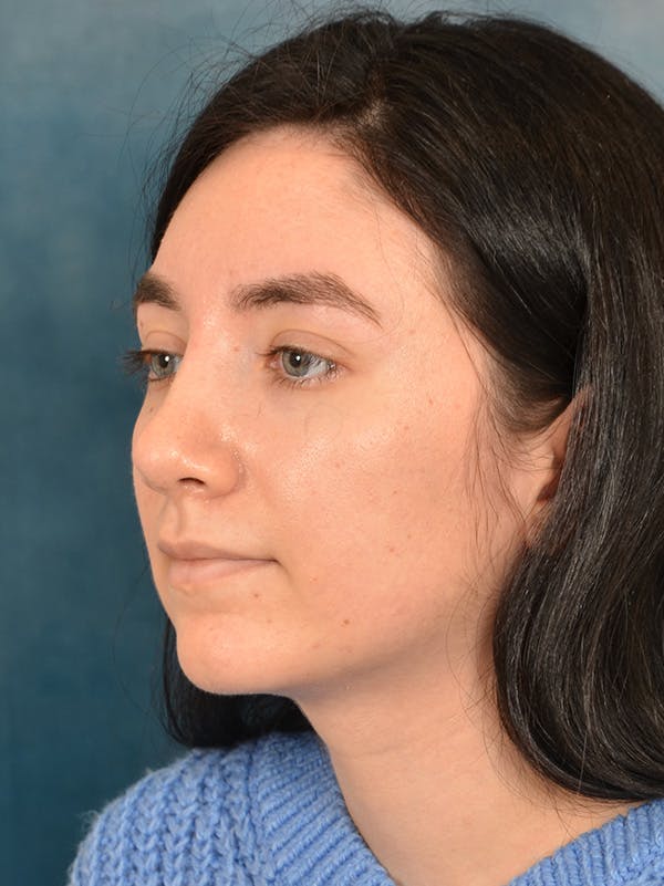 Rhinoplasty Before & After Gallery - Patient 146804354 - Image 10
