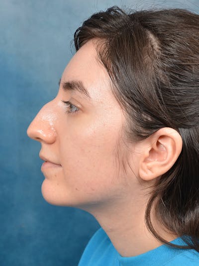Rhinoplasty Before & After Gallery - Patient 146804354 - Image 1