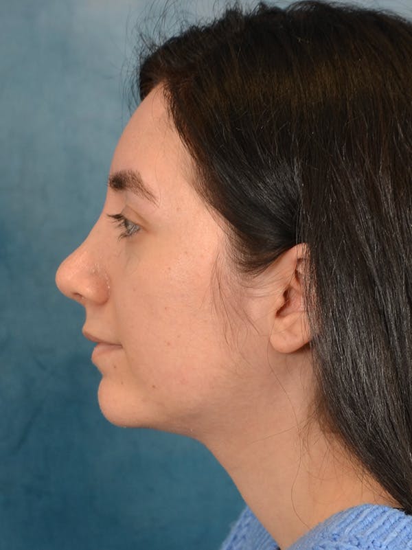 Rhinoplasty Before & After Gallery - Patient 146804354 - Image 2