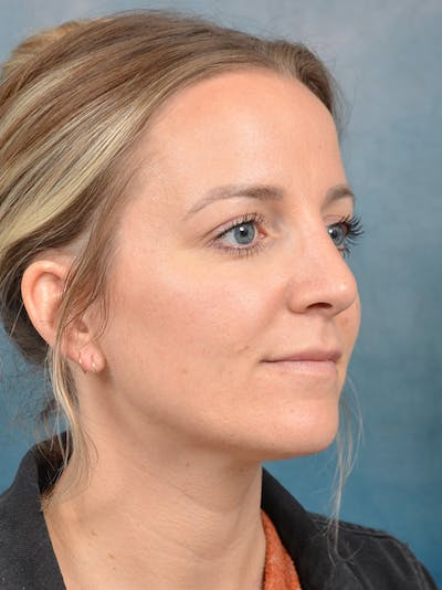 Rhinoplasty Before & After Gallery - Patient 146208719 - Image 6