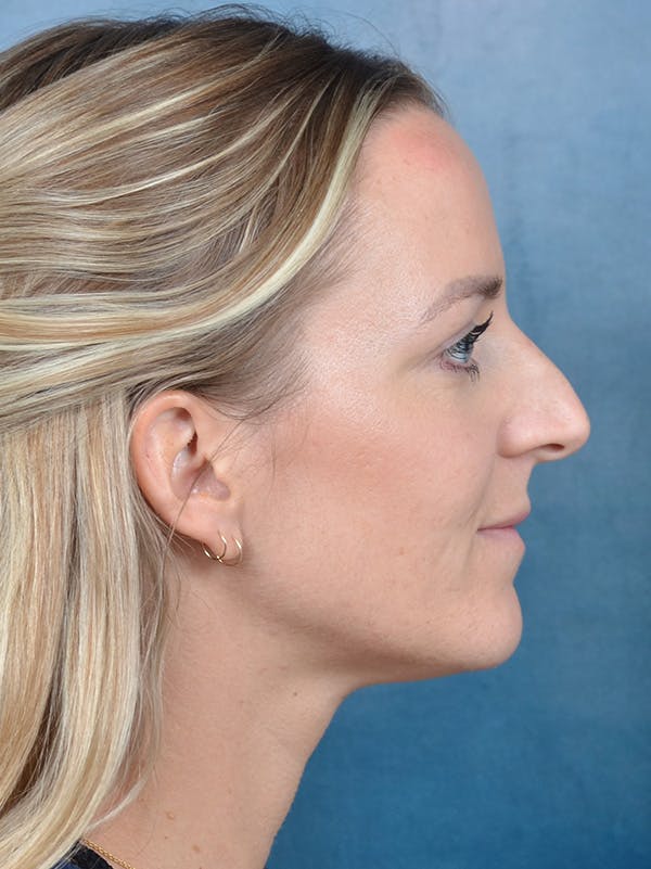 Rhinoplasty Before & After Gallery - Patient 146208719 - Image 7