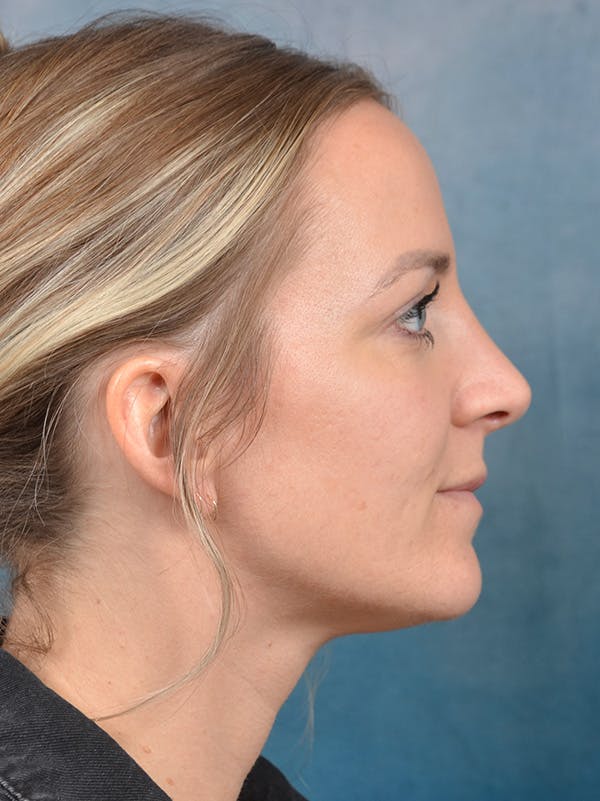 Rhinoplasty Before & After Gallery - Patient 146208719 - Image 8