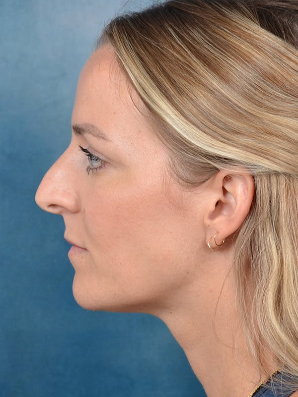 Rhinoplasty Before & After Gallery - Patient 146208719 - Image 1